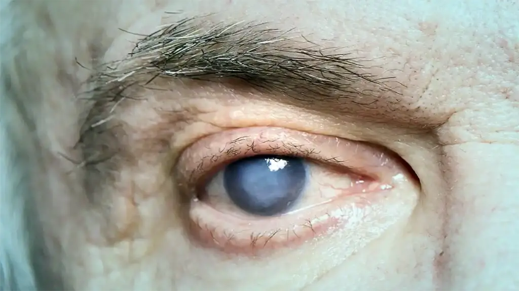 أزالة-المياه-الزرقاء-الجلوكوما