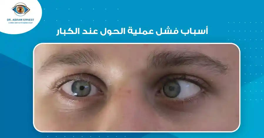 أسباب فشل عملية الحول عند الكبار