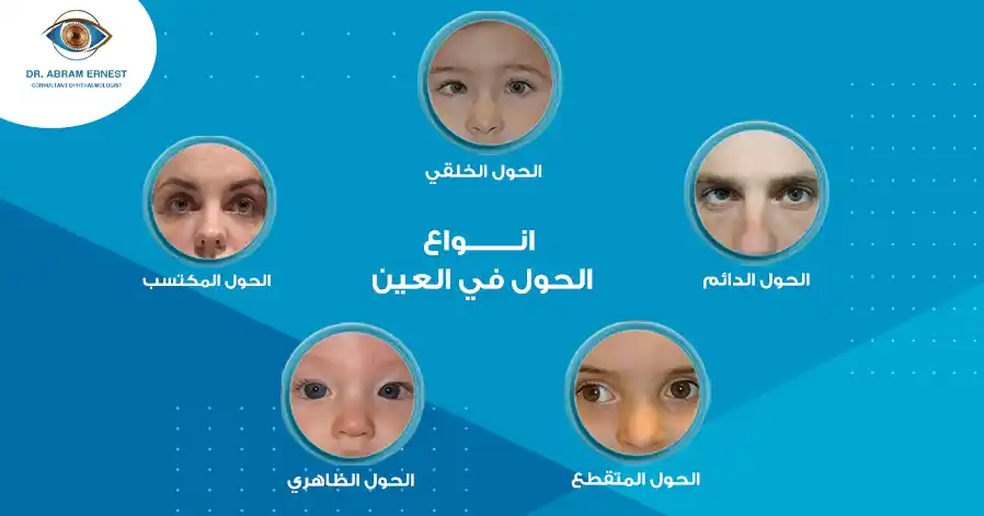 انواع الحول في العين