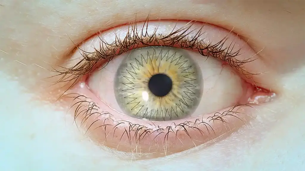 زراعة القرنية