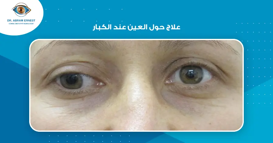 علاج حول العين عند الكبار