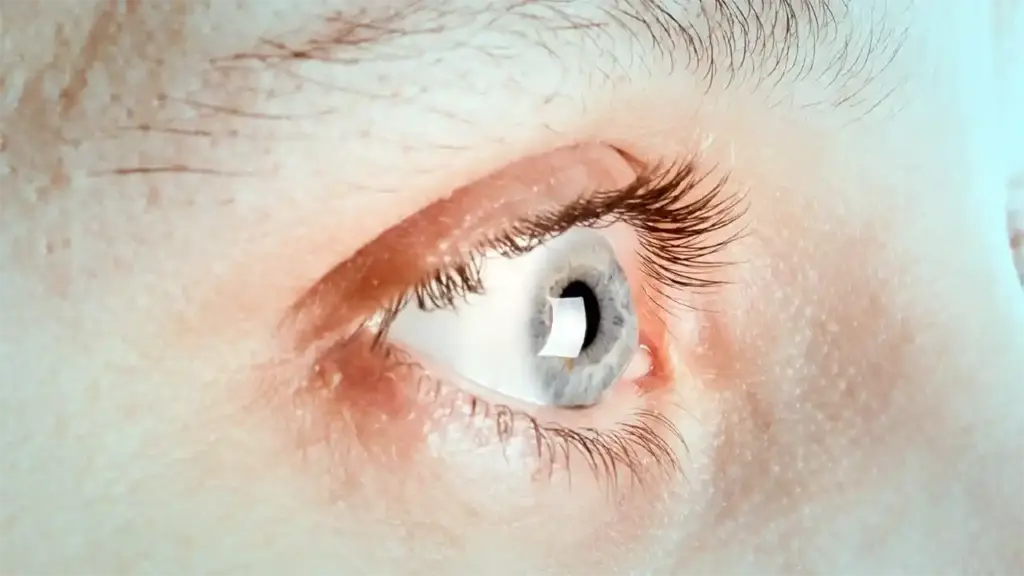 عمليات القرنية المخروطية