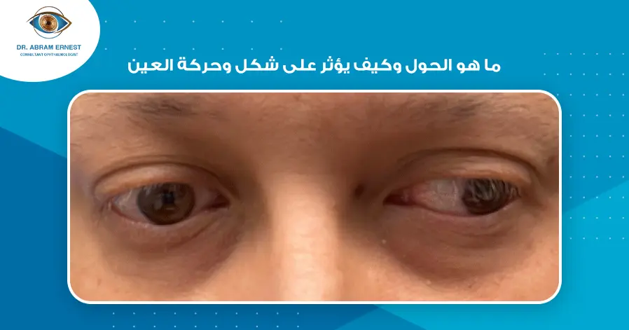 عملية علاج الحول