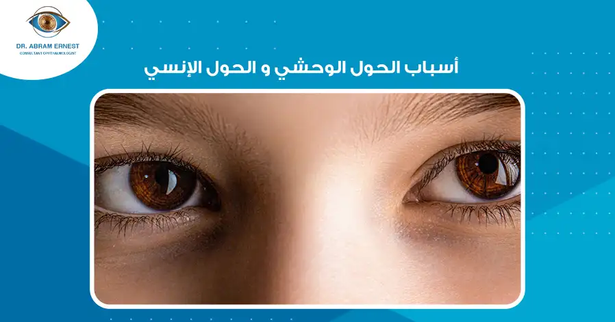 أسباب الحول الوحشي و الحول الإنسي
