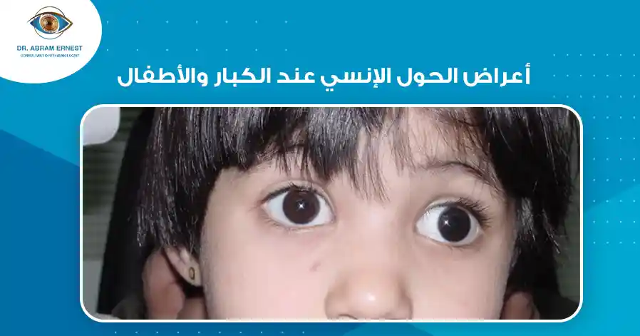 أعراض الحول الإنسي عند الكبار والأطفال