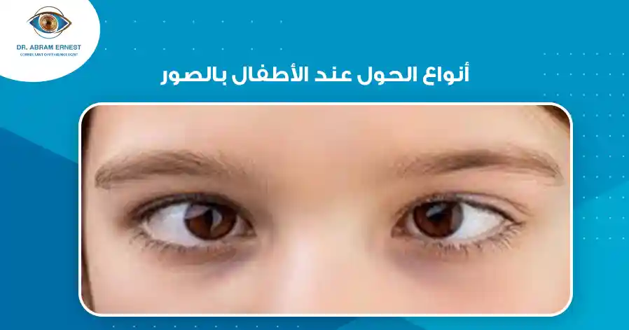 أنواع الحول عند الأطفال بالصور