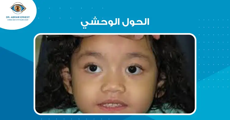 الحول الوحشي