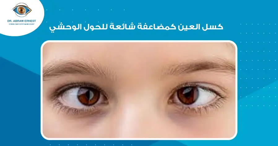 كسل العين كمضاعفة شائعة للحول الوحشي