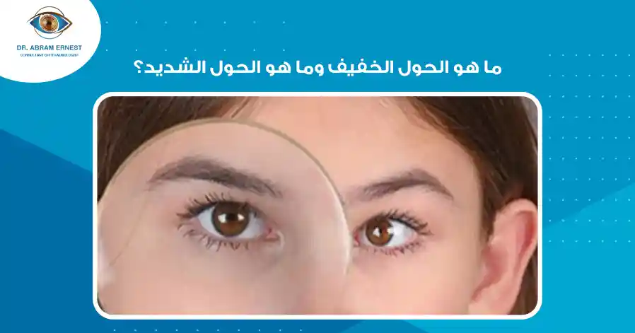 ما هو الحول الخفيف و الحول الشديد؟