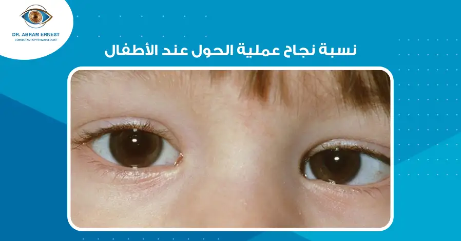 نسبة نجاح عملية الحول عند الأطفال