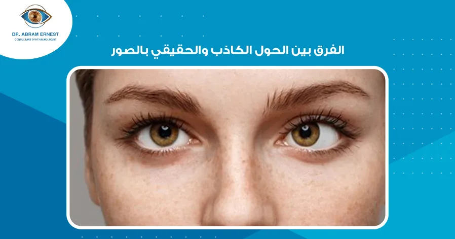 الفرق بين الحول الكاذب والحقيقي بالصور