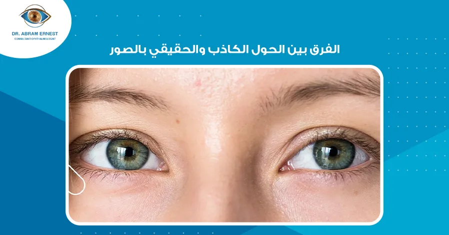 الفرق بين الحول الكاذب والحقيقي بالصور