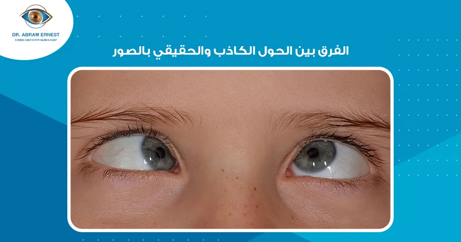 الفرق بين الحول الكاذب والحقيقي بالصور