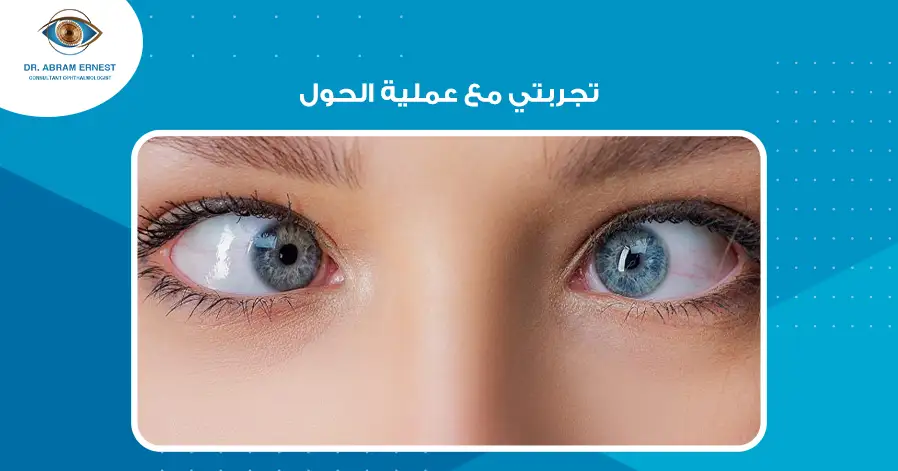 تجربتي مع عملية الحول