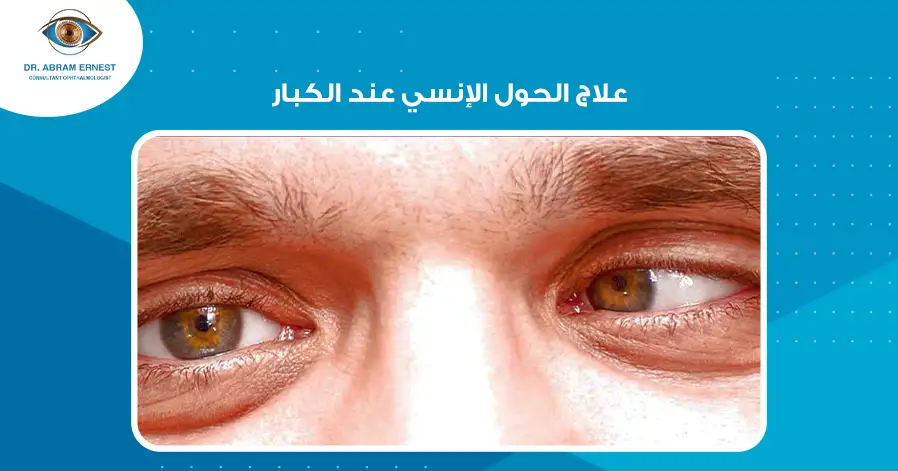 علاج الحول الإنسي عند الكبار