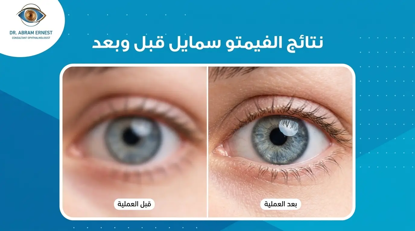 نتائج عملية فيمتو سمايل قبل وبعد