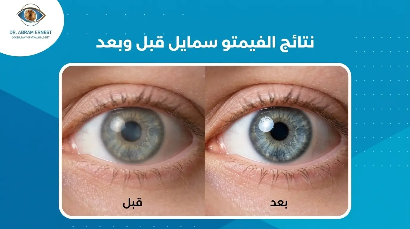 نتائج عملية فيمتو سمايل قبل وبعد
