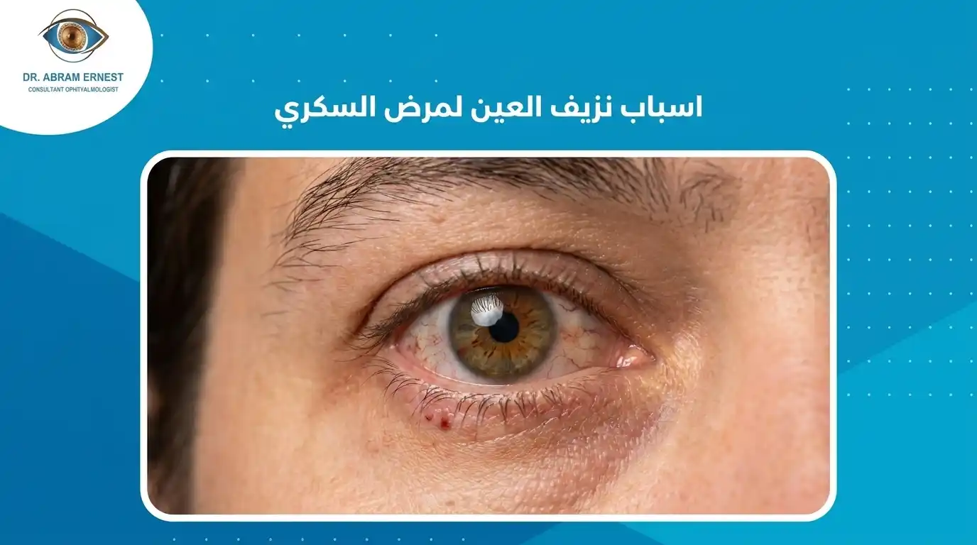 اسباب نزيف العين لمرض السكري