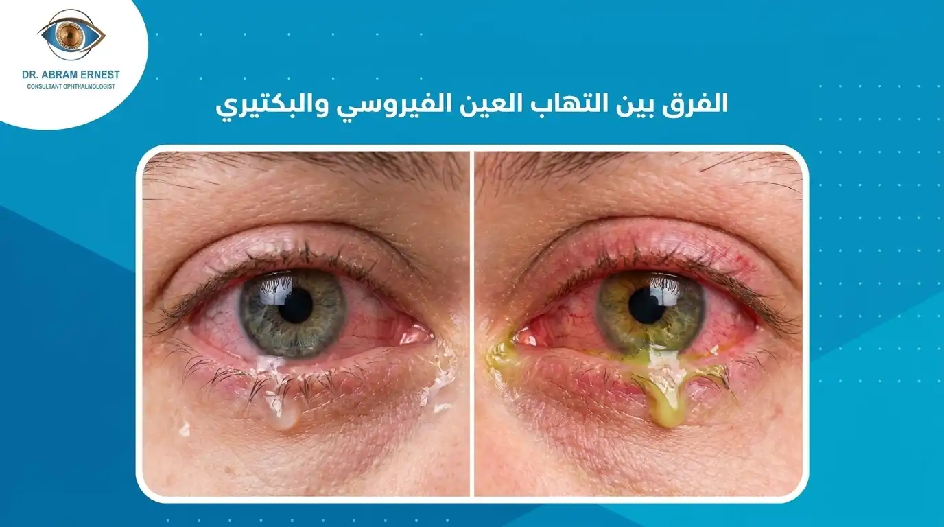 الفرق بين التهاب العين الفيروسي والبكتيري