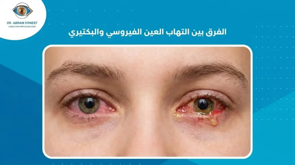 الفرق بين التهاب العين الفيروسي والبكتيري