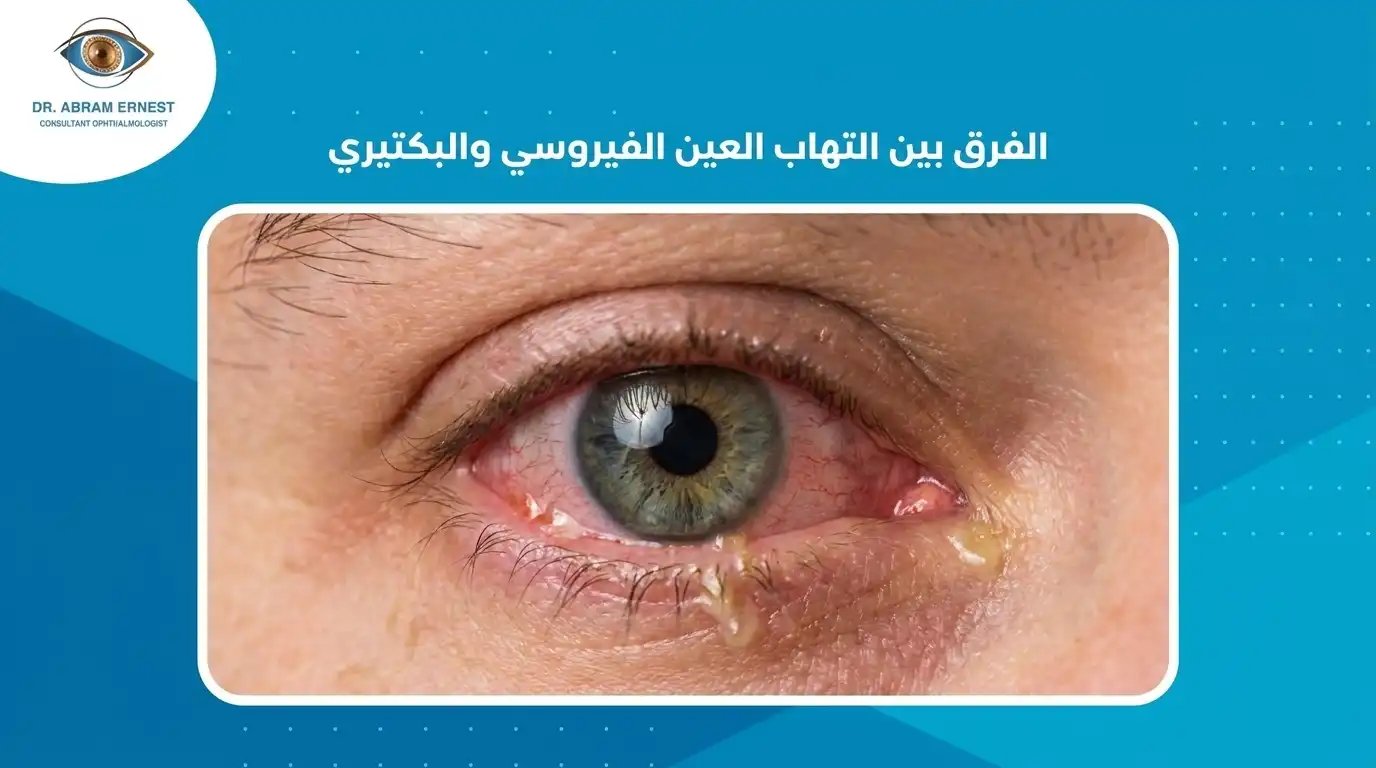 الفرق بين التهاب العين الفيروسي والبكتيري