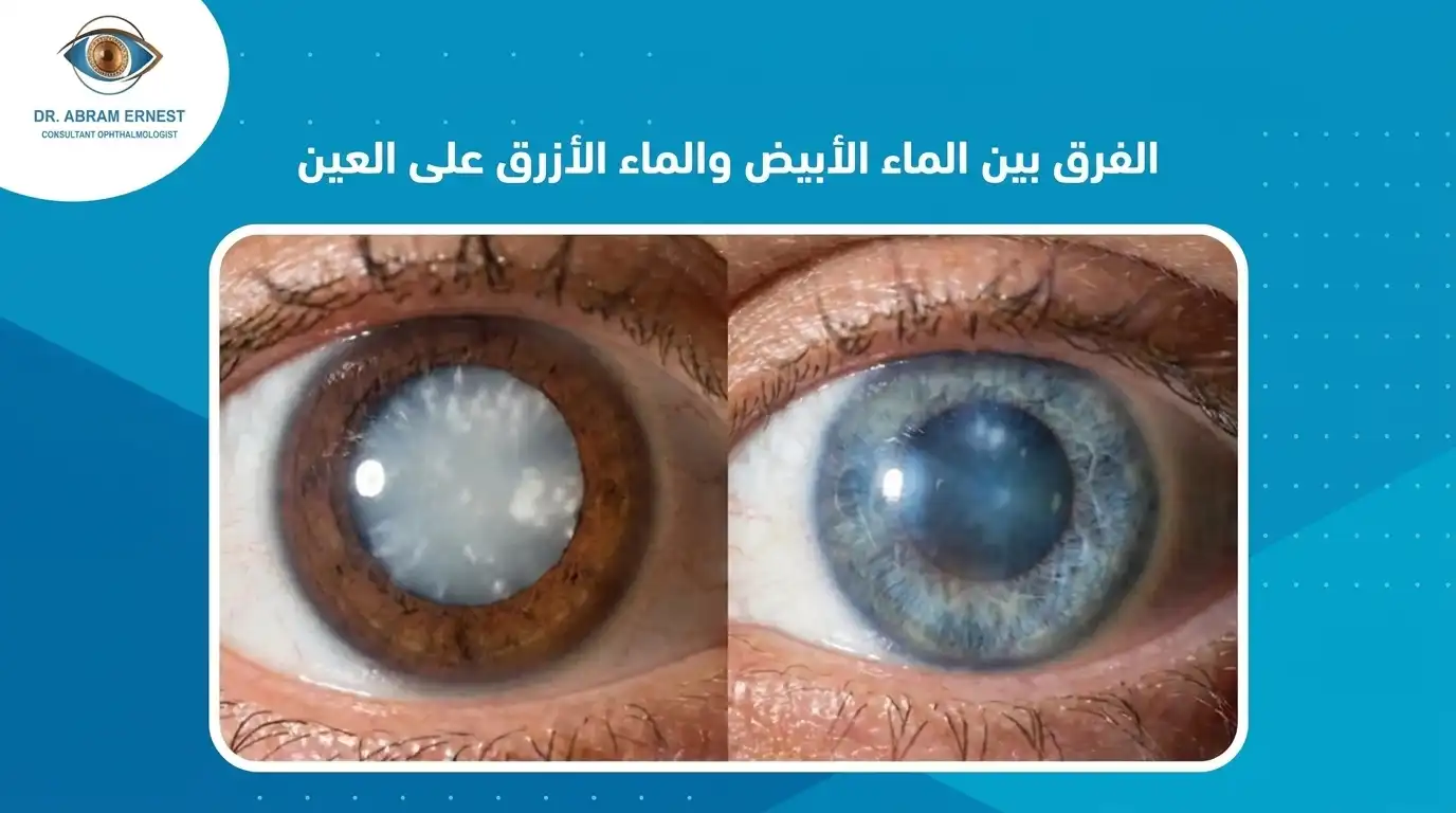 الفرق بين الماء الأبيض والماء الأزرق على العين