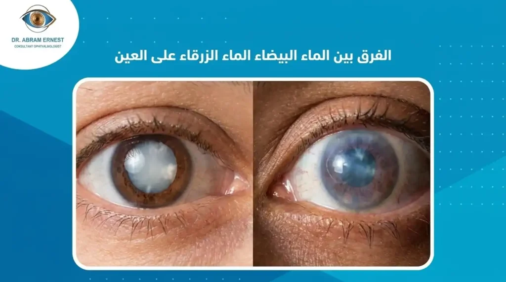 الفرق بين الماء الأبيض والماء الأزرق على العين
