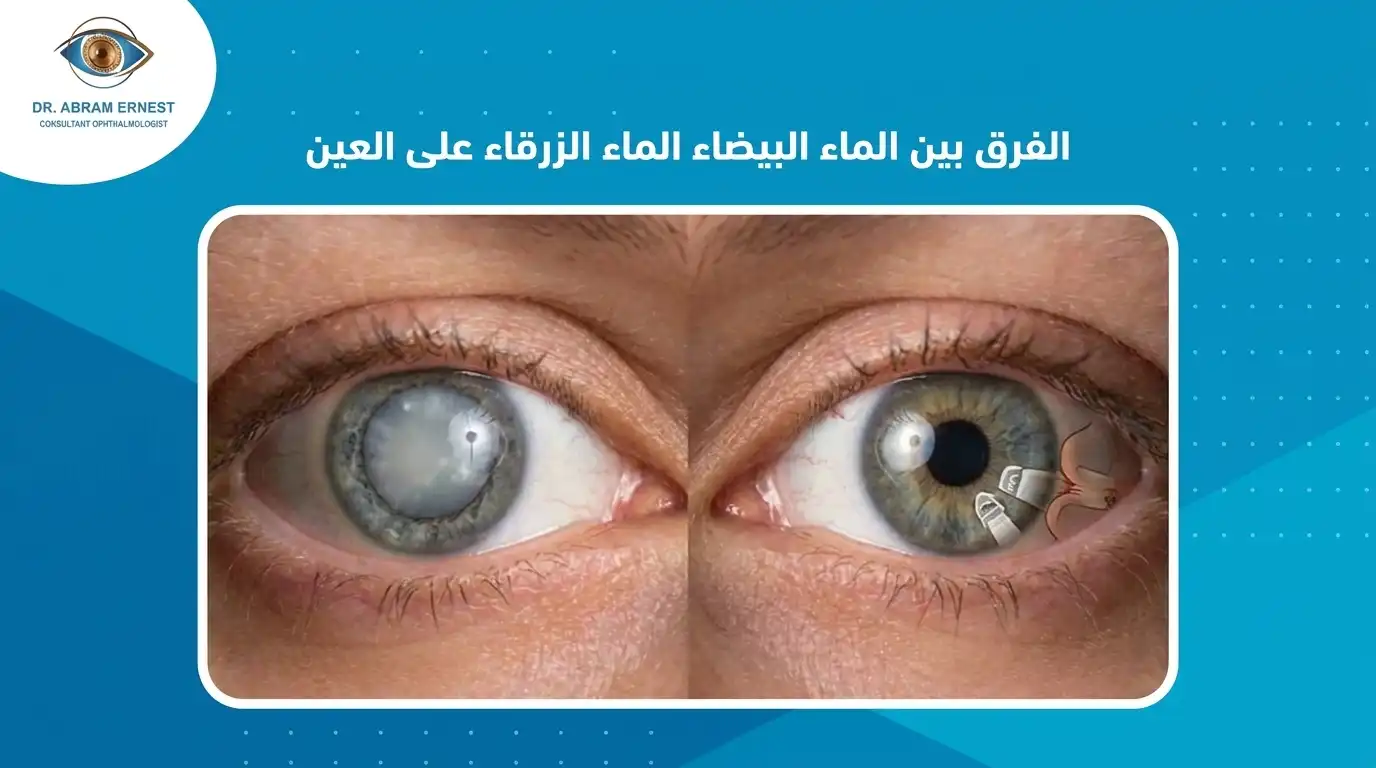 الفرق بين الماء الأبيض والماء الأزرق على العين