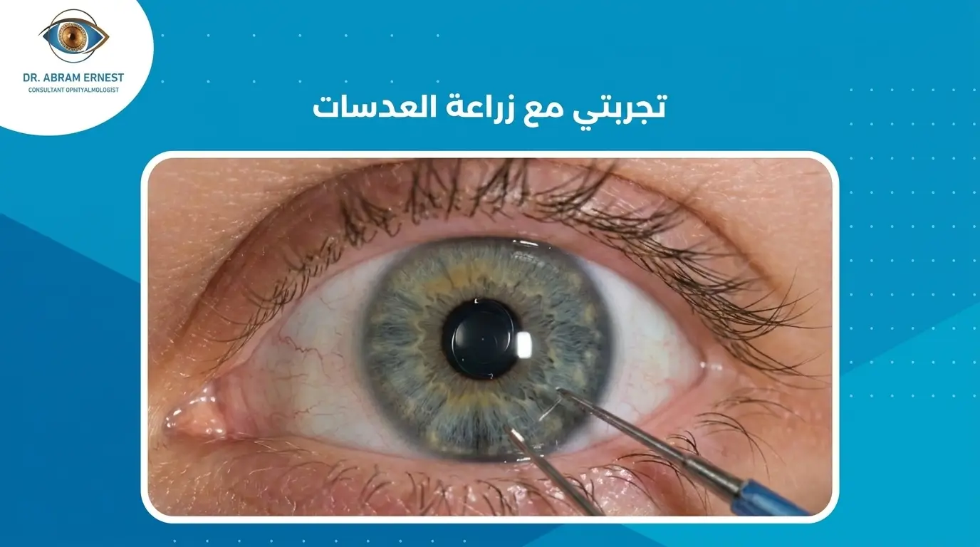 تجربتي مع زراعة العدسات