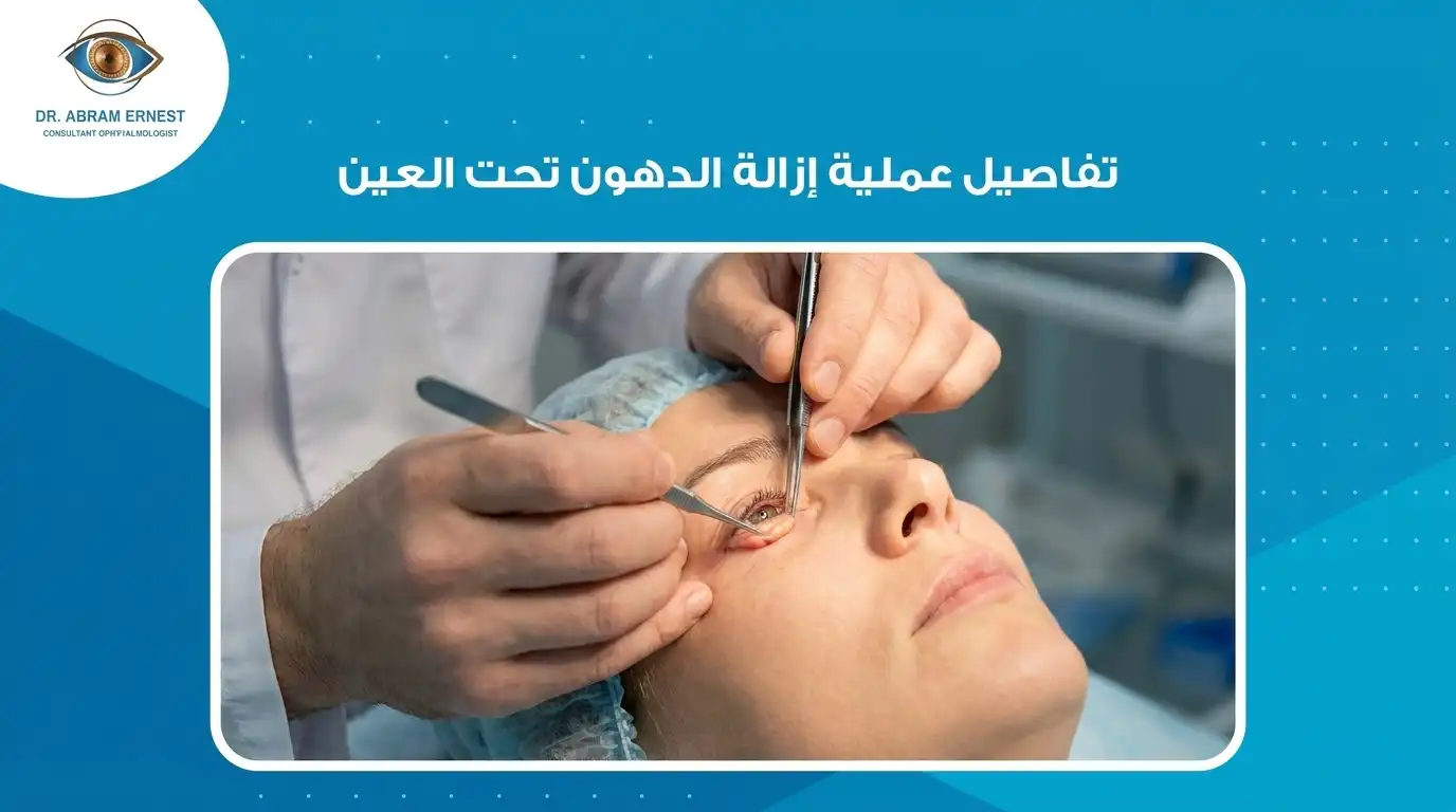 تفاصيل عملية إزالة الدهون تحت العين