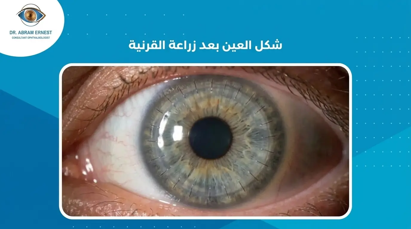 شكل العين بعد زراعة القرنية