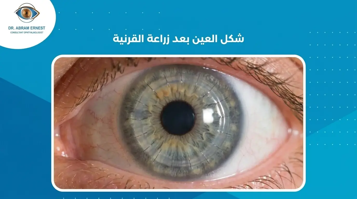 شكل العين بعد زراعة القرنية