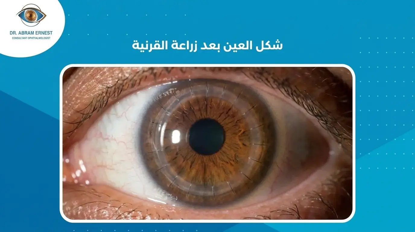 شكل العين بعد زراعة القرنية