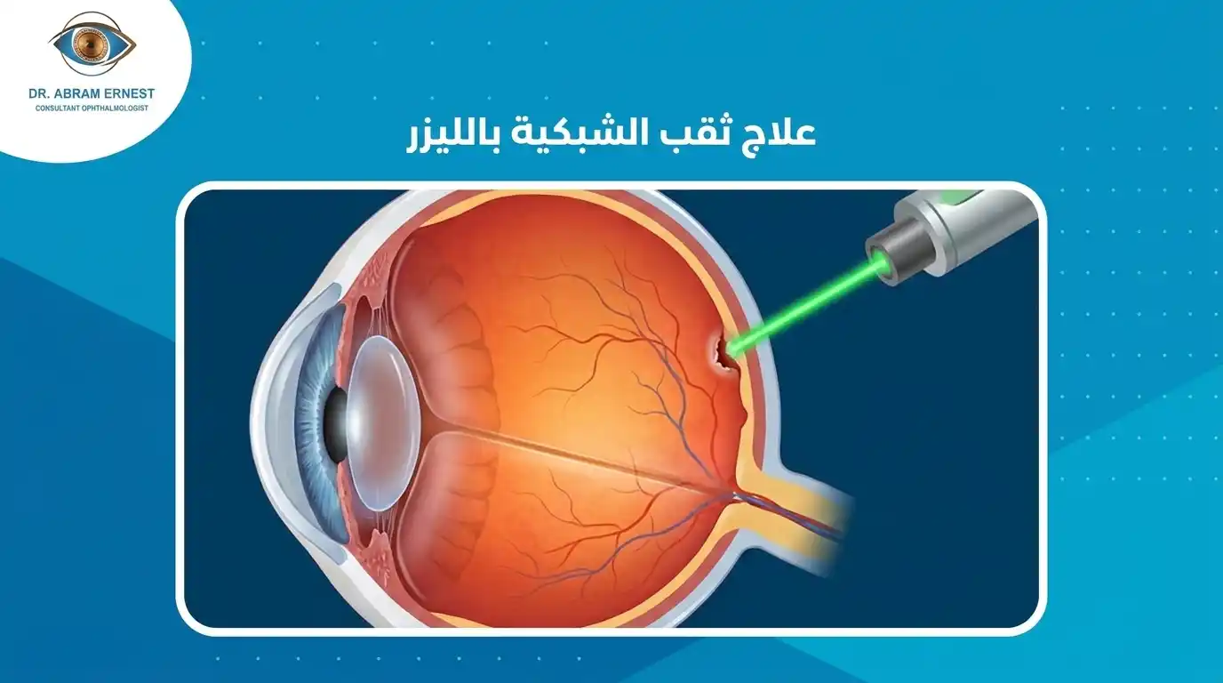 علاج ثقب الشبكية بالليزر