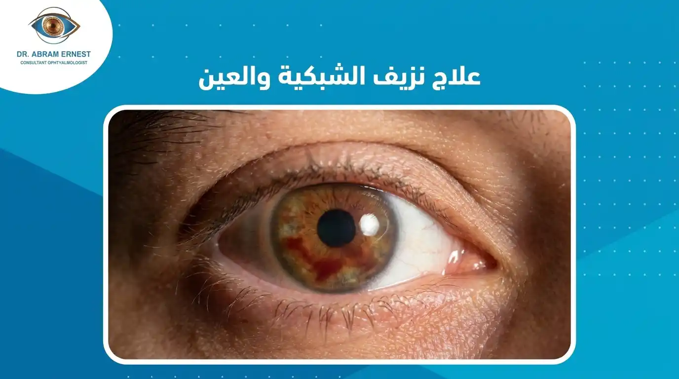 علاج نزيف الشبكية والعين
