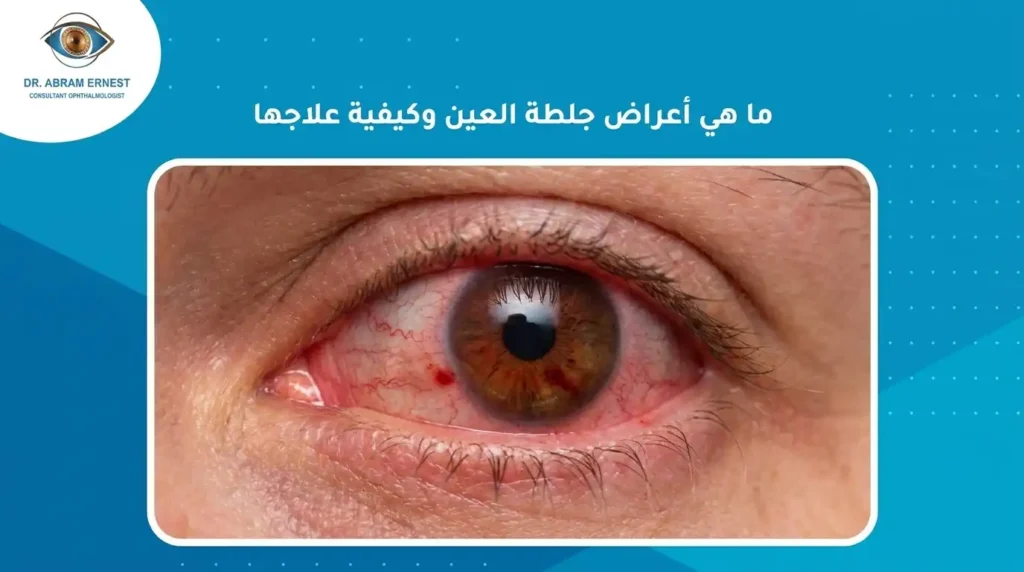 ما هي أعراض جلطة العين وكيفية علاجها